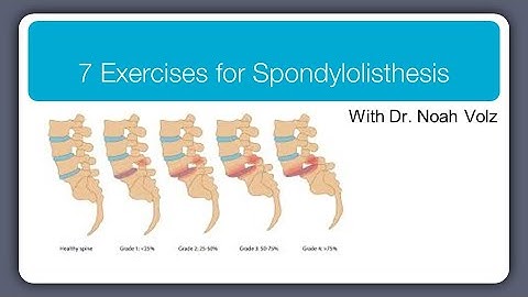 7 Exercises For Spondylolisthesis