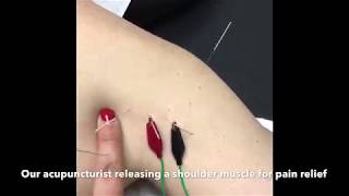 Acupuncture for shoulder muscle pain relief in NYC