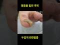 발톱이 밟힌 후에 두껍게 변형된 빌톱