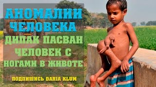 МАЛЬЧИК С ЛИШНИМИ КОНЕЧНОСТЯМИ ( Дипак Пасван ) МАЛЬЧИК С ЛИШНИМИ КОНЕЧНОСТЯМИ ( Дипак Пасван )