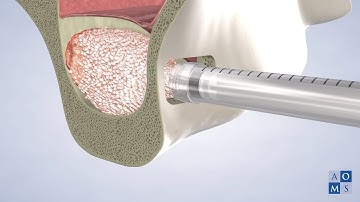 Bone Graft/Sinus Augmentation in Amarillo, TX | Amarillo Oral & Maxillofacial Surgery