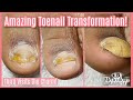 👣HOW TO GET RID OF TOENAIL FUNGUS AT HOME  👣