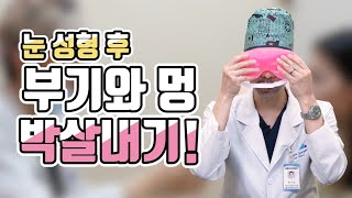 의사가 직접 알려준다!! 수술 후 멍 부기 빼는법!! 쌍수하고 부기와 멍으로 더이상 울지마ㅠ