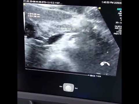 Острый Панкреатит.