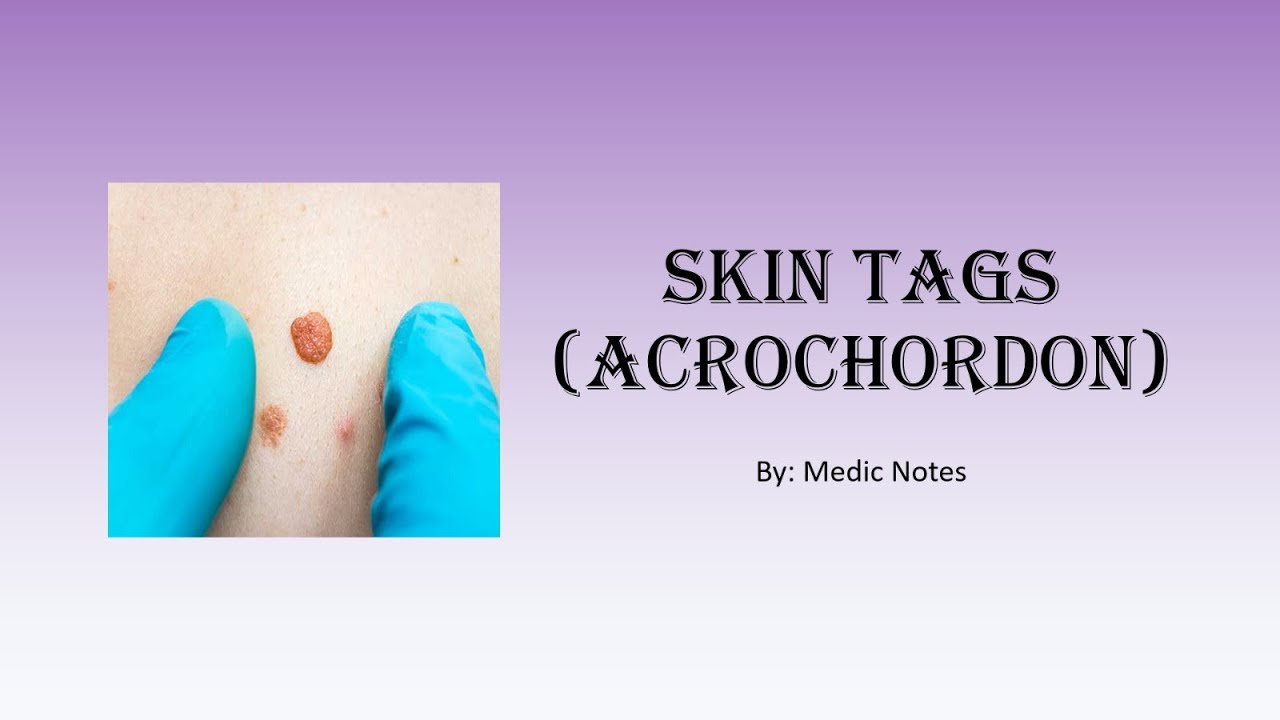 Skin tags causes and pathophysiology YouTube
