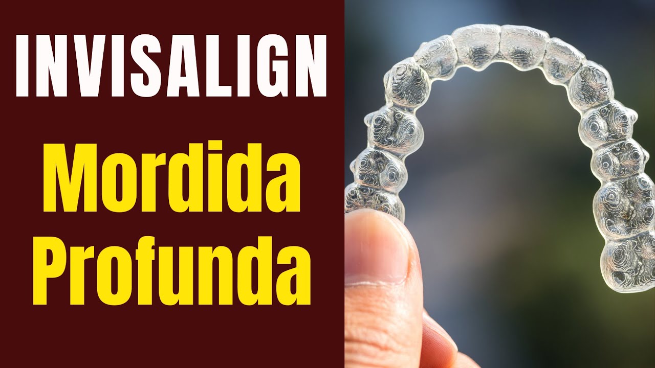 Correção da Mordida Profunda com Invisalign 