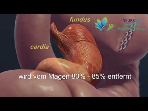 Video: Gastrektomie Mit Vertikaler Hülse: Operation Für Gewicht