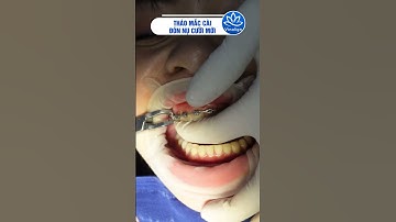 Tháo mắc cài "trả lại" nụ cười tự tin  #nambuivinalign #niềngrăng