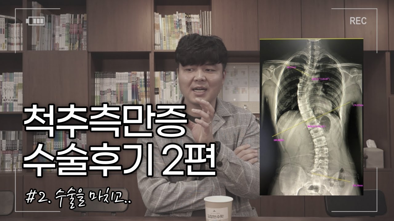아산병원 척추측만증 수술후기 2편