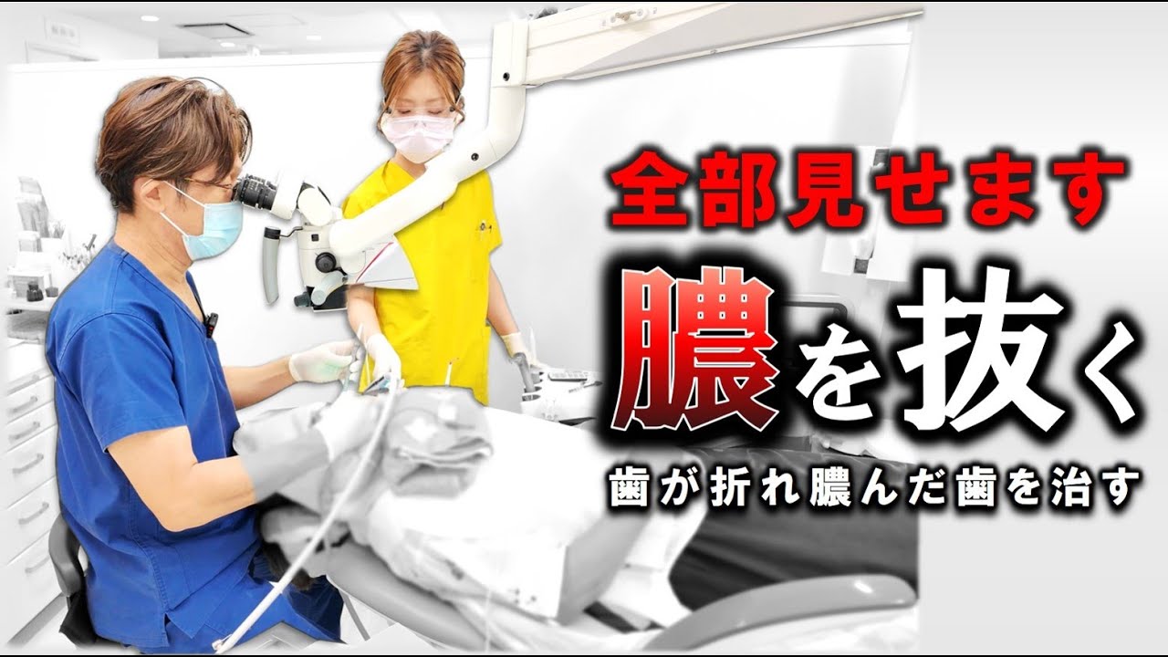 【全部見せます】歯が折れ膿んだ歯を治す！＃膿　＃歯医者　＃根管治療