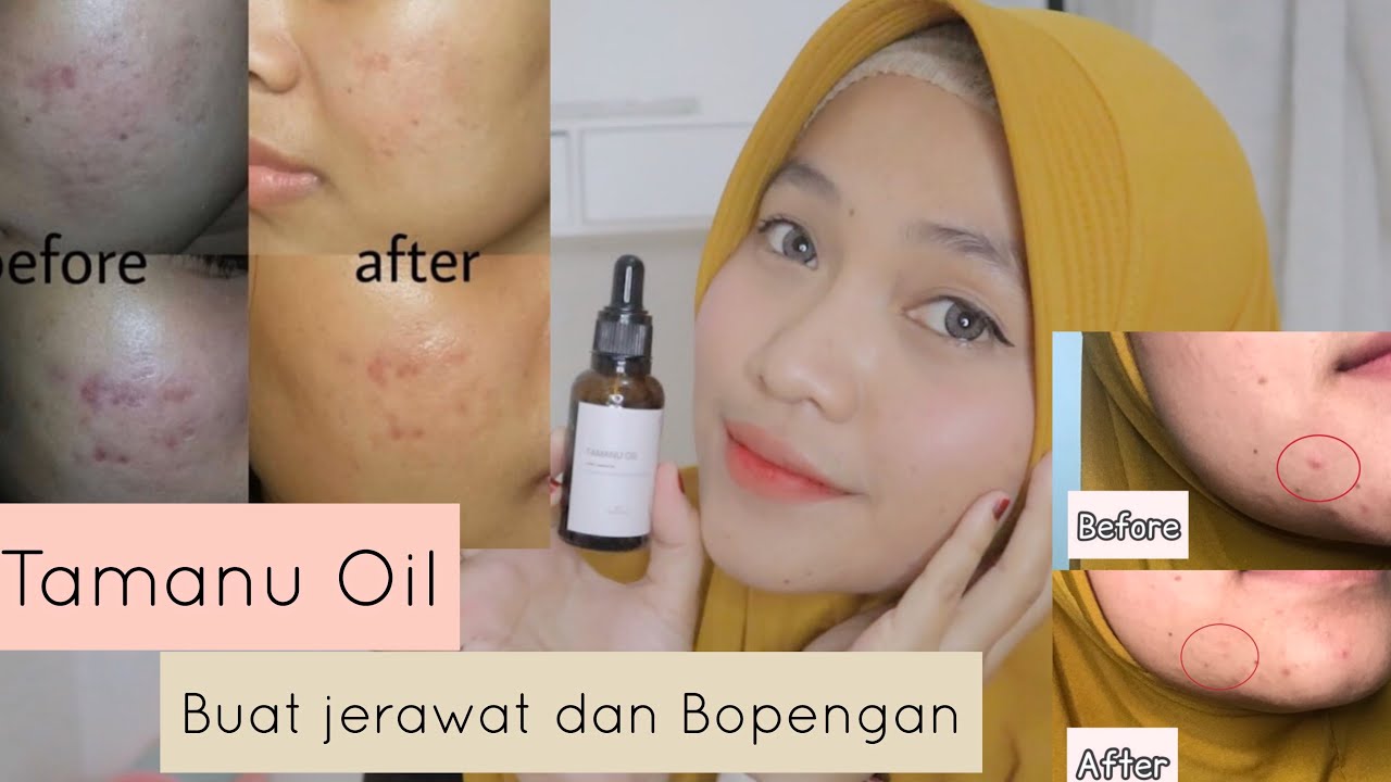 Review Tamanu Oil Mengatasi Jerawat Dan Bopengan Youtube