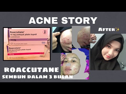 My Acne Story | 3 Months With Roaccutane || Sembuh Dari Jerawat Batu Semuka