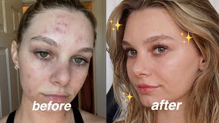 Everyday Natural Makeup Routine with Acne | how i cover my acne