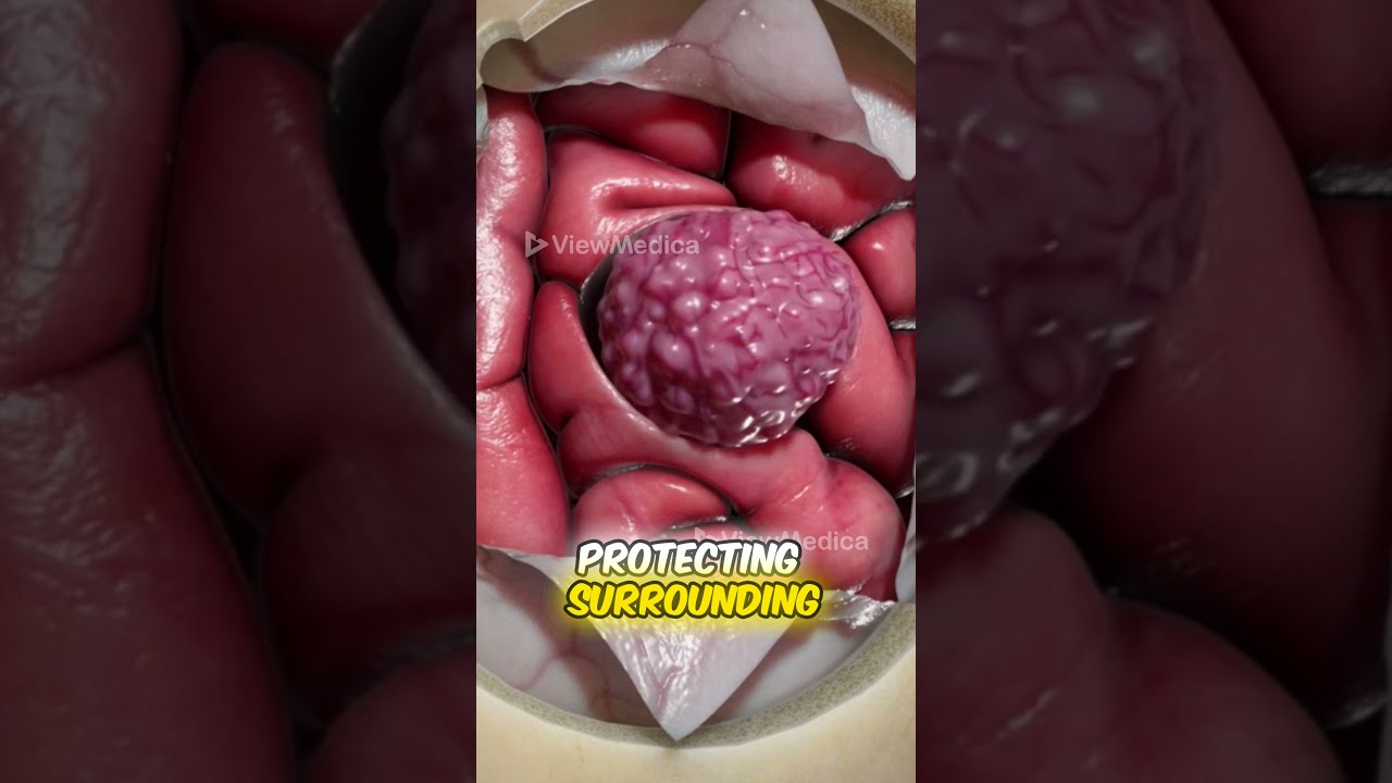 Craniotomy To Remove A Brain Tumor 3D Animation 