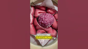 Craniotomy To Remove A Brain Tumor 3D Animation 