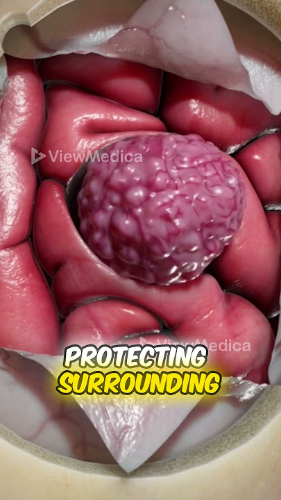 Craniotomy to Remove a Brain Tumor (3D Animation)