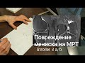 Повреждение мениска по МРТ 3а, 3б ( 3a, 3b ) степени по Stoller. Какая тактика лечения?