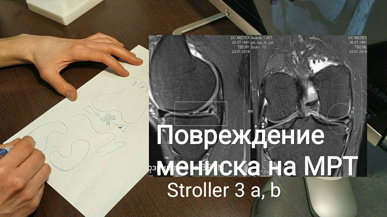 Разрыв мениска степени по stoller. Степени повреждения менисков по Столлеру. Повреждения медиального мениска 3 b степень. Разрыв медиального мениска по Stoller. Повреждение 2 степени по Stoller.