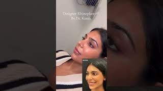 Rhinoplasty Before And After 