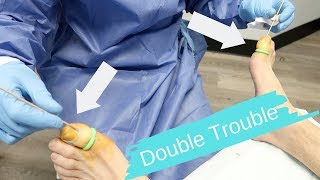 Double Ingrown Trouble | Double the Surgery