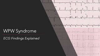 Wolff-Parkinson-White (WPW) Syndrome ECG