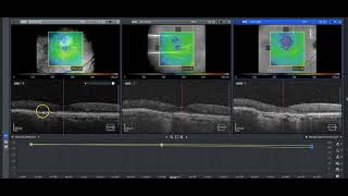 Retina HotMic 05