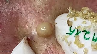 BLACKHEADS AND CYSTIC ACNE REMOVAL ON MANS FACE 044