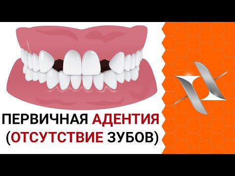 Первичная АДЕНТИЯ (Отсутствие зубов) | Причины. Лечение.