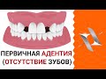 Первичная АДЕНТИЯ (Отсутствие зубов) | Причины. Лечение.