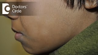 How to cure white patches on face in a young individual? - Dr. Rasya Dixit screenshot 2