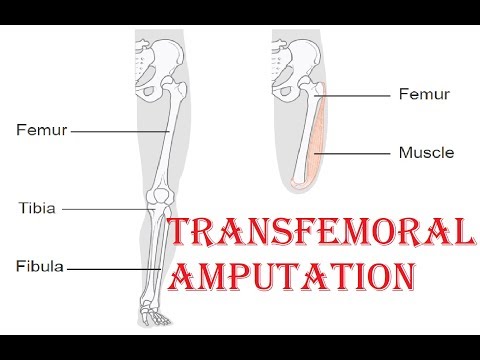 Video: Modulär Motorstyrning Av Ljudbenet Hos Personer Med Trans-femoral Amputation