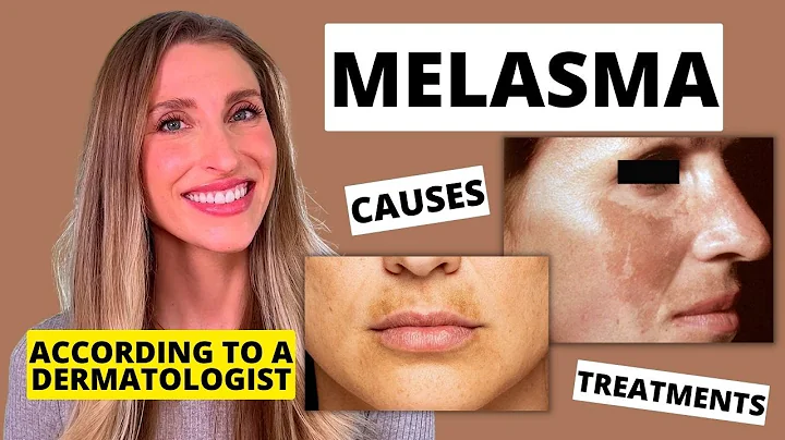 Best Melasma Treatment? Dermatologist Explains Melasma: Causes, At Home Treatments, & More