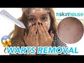 GOT RID OF WARTS ON MY FACE!