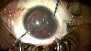 AIOC2022 - VT260 - Femtosecond Laser Assisted cataract surgery (FLACS) in a challenging...