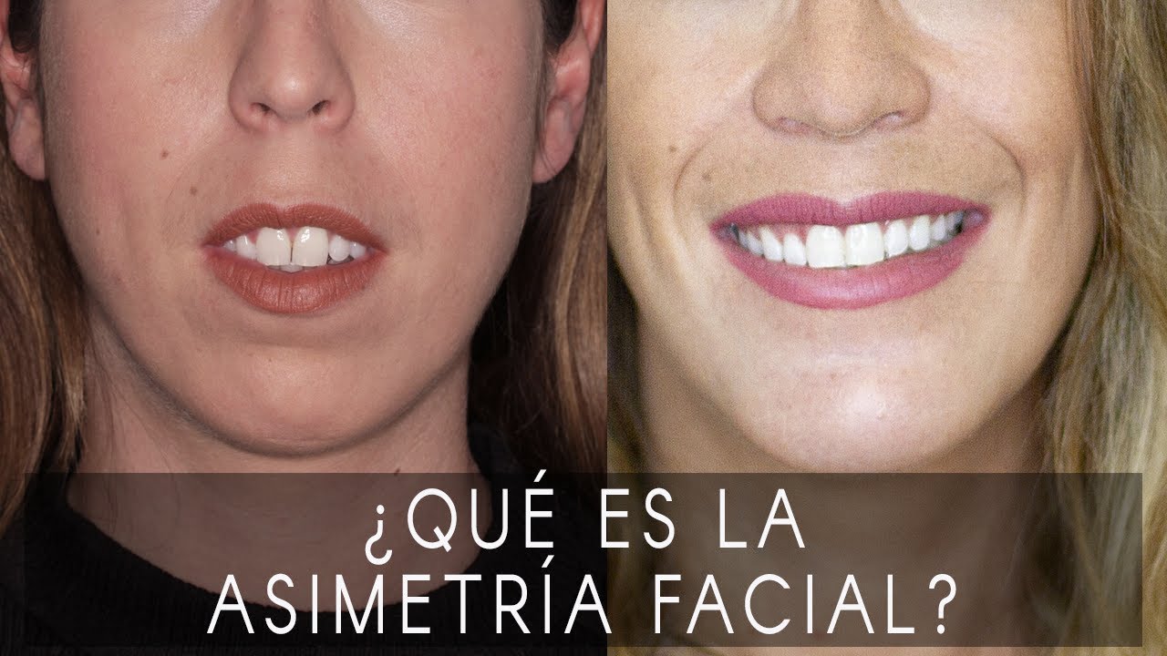 Asimetría facial qué es y cómo tener un rostro simétrico YouTube Asimetría facial qué es y cómo tener un rostro simétrico YouTube