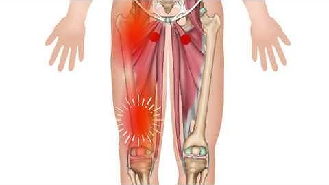 Hip Adductors - Trigger Point Anatomy