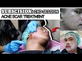 Second session subcision for acne scars  5 in 1 synergistic acne scar treatment