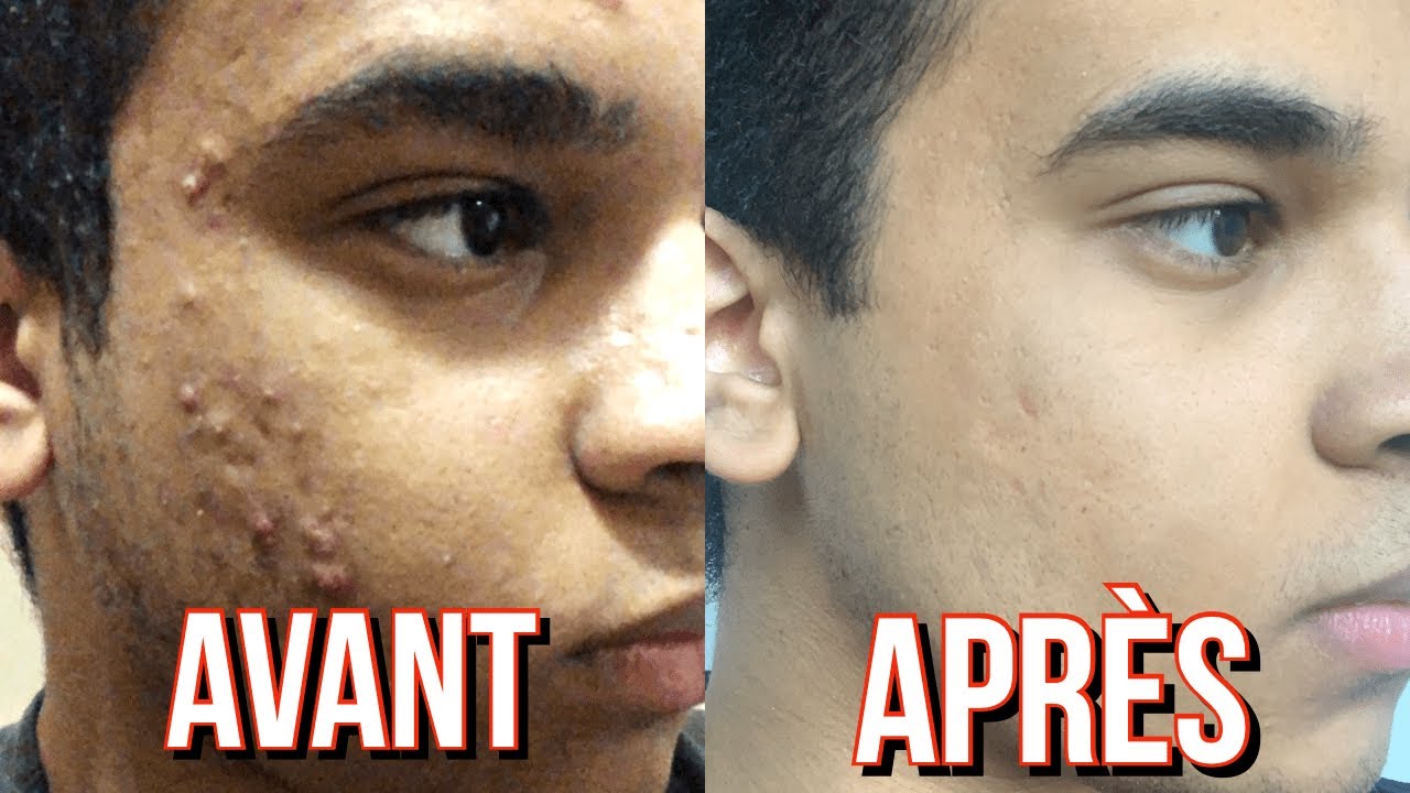 Roaccutane / Curacné: Evolution Avant/Après, Perte De Cheveux et RDV Chez La Psy !