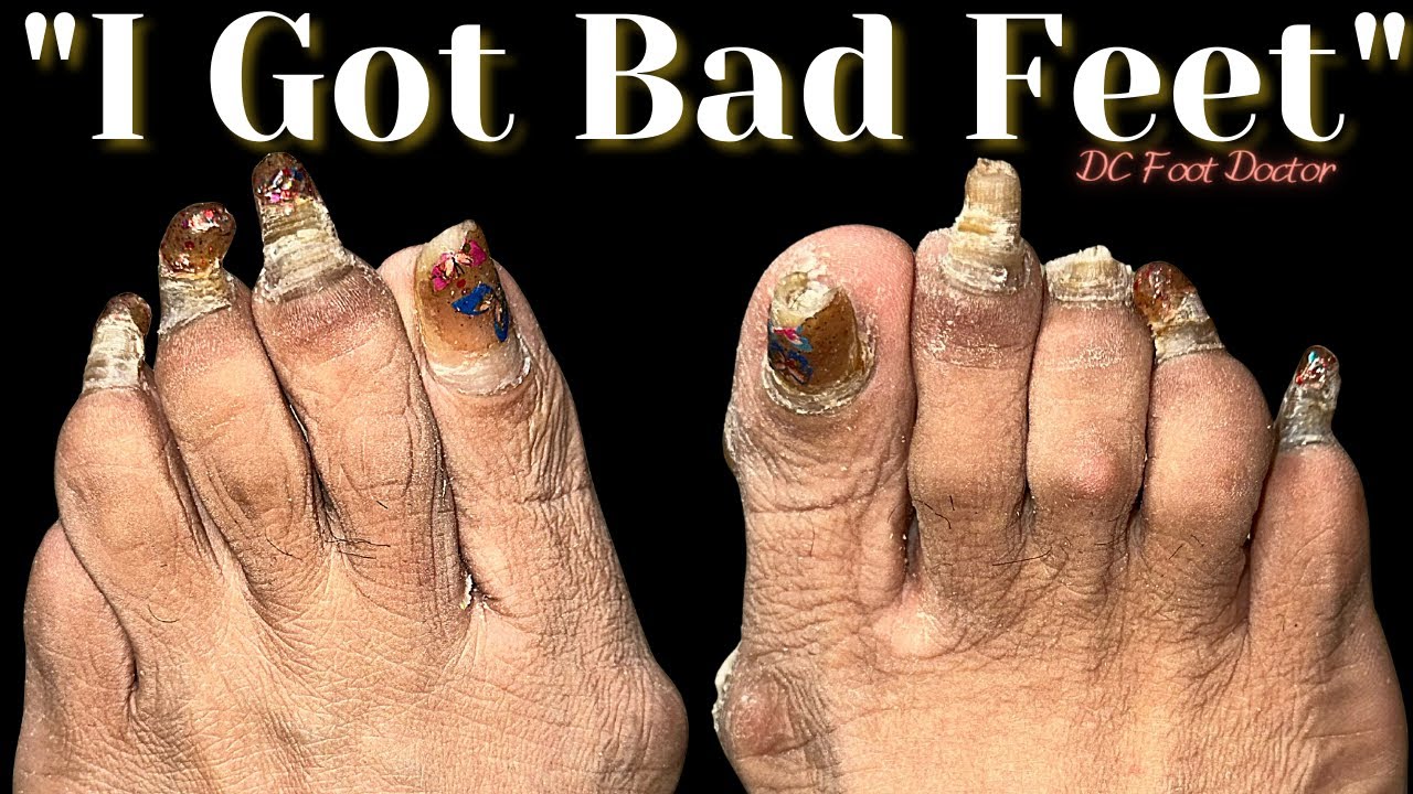 I Got Bad Feet Part 1 Trimming Fungal Toenails YouTube