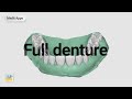 Designing a teeth  gum separated full denture with medit design app