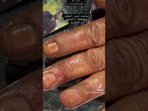 علاج البهاق وتصبغات الجلد مع مسيو مانو