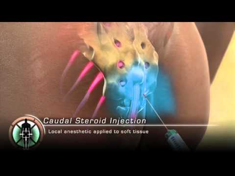 caudal steroid injection recovery