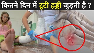 कितने दिन में टूटी हड्डी जुड़ती है ? | How Bone Heal After Facture screenshot 2