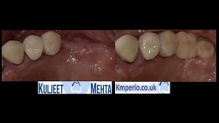 Dental Implant with simultaneous sinus lift and GBR by Dr Kuljeet Singh Mehta-Periodontist 1,039 views 2 years ago 16 minutes