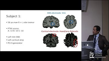 Closed-Loop Deep Brain Stimulation For Essential Tremors - Andrew L. Ko, MD