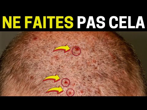 Vidéo: 3 façons de faire repousser les cheveux après une infection fongique du cuir chevelu