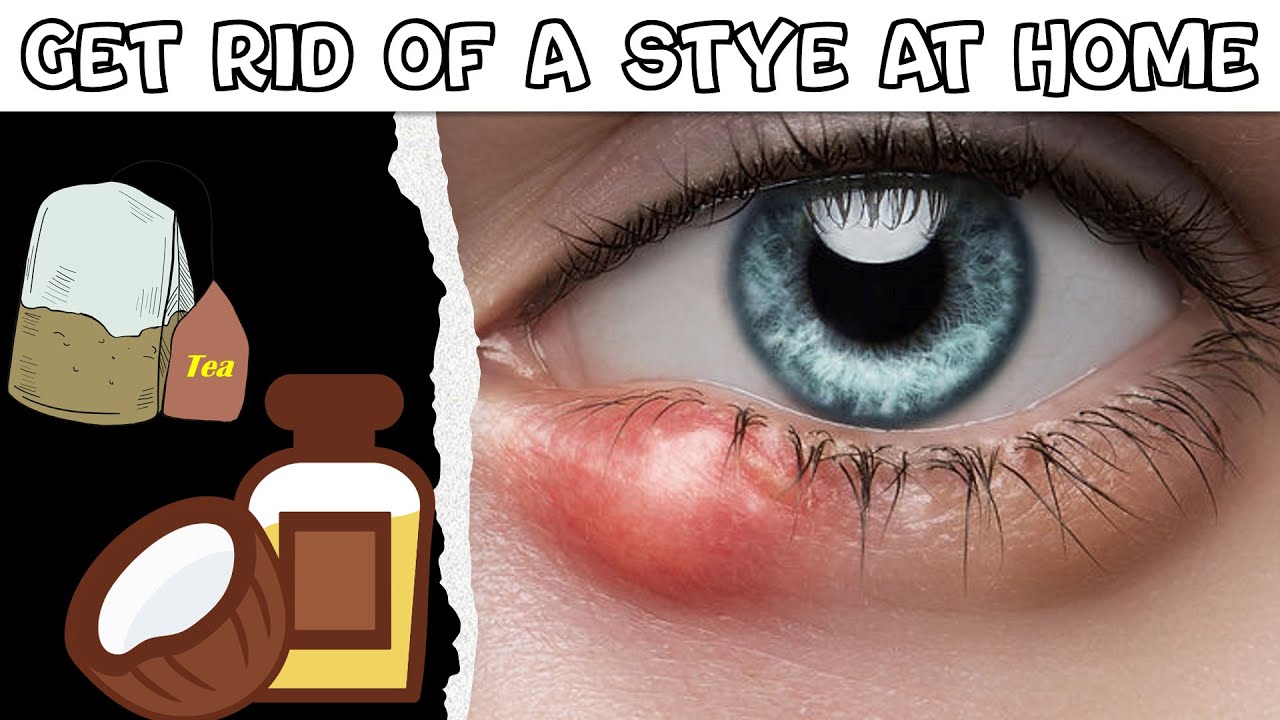 ⁣How To Get Rid Of A Stye At Home |Natural Remedies For Stye |Best Ways To Get Rid Of A Stye Easily