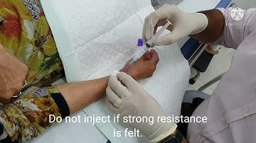 WRIST DEQUERVAINS STEROID INJECTION/ DR PRADEEP BALA