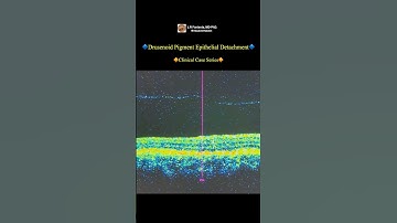 Drusenoid Pigment Epithelial Detachment.
