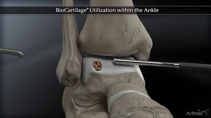 BioCartilage® Utilization within the Ankle